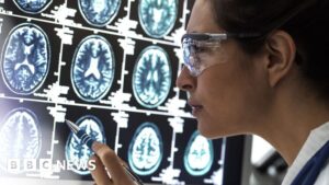 Alzheimer's drug lecanemab hailed as momentous breakthrough